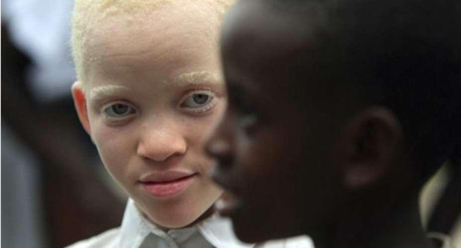Albinism: What Do You See? My Complexion Or My Person?