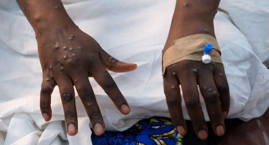 Ghana records 7 new Mpox cases, total cases rise to 98