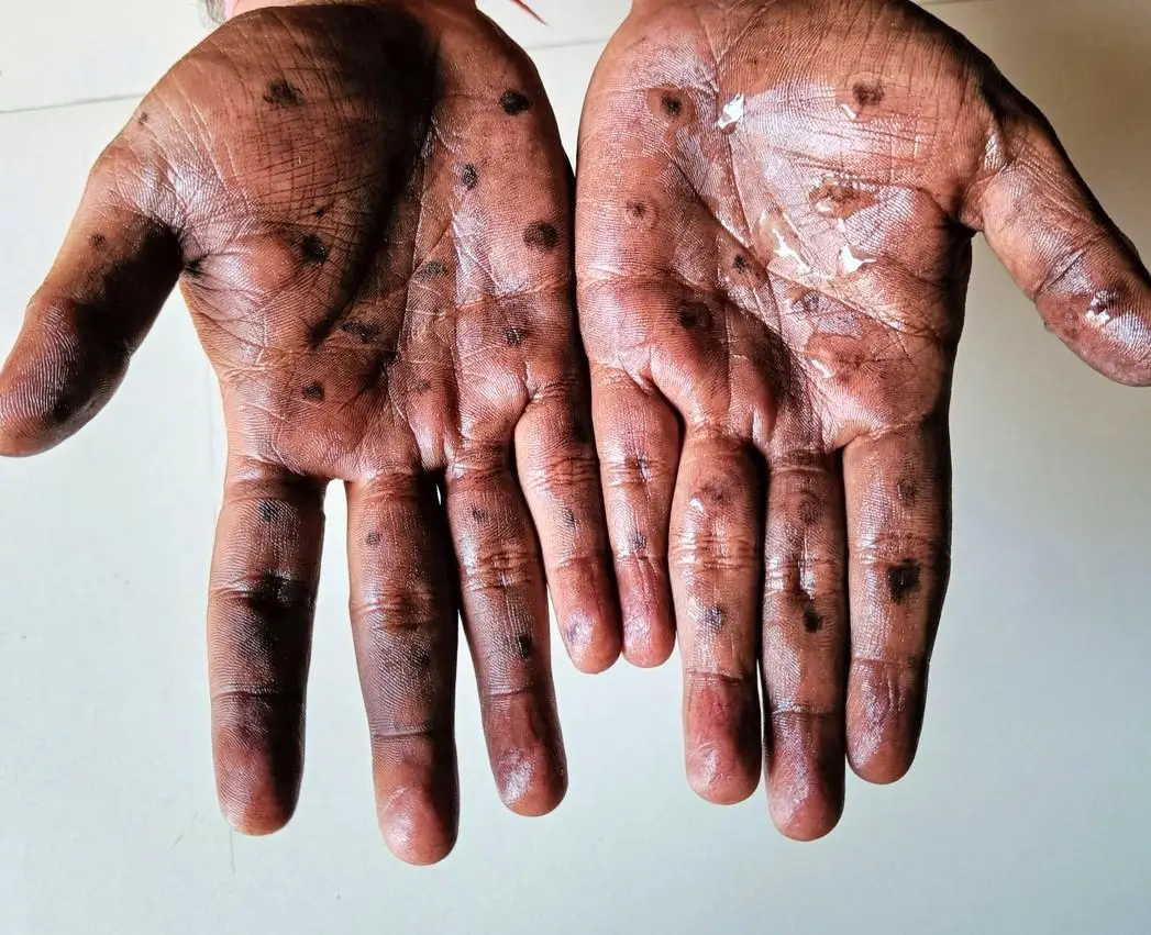 Mpox cases now 107