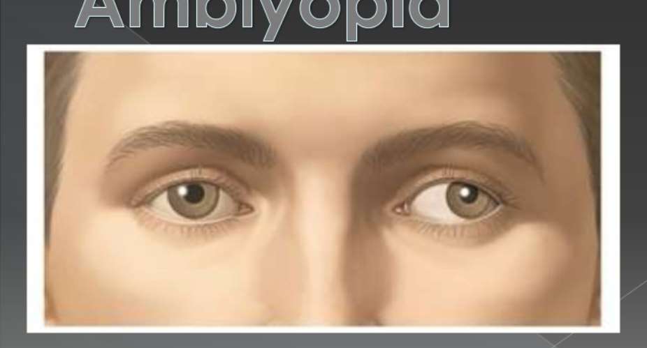 Amblyopia – the lazy eye condition to watch out for