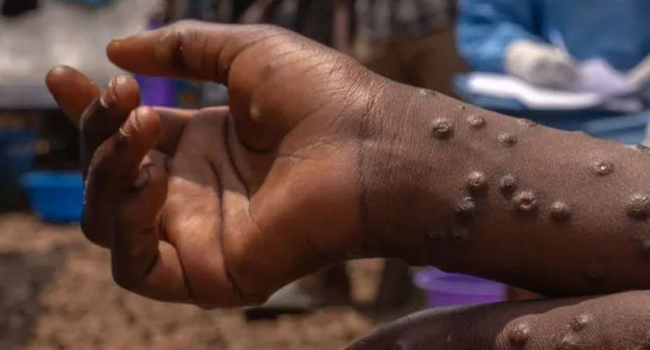 Mpox cases climb to 218 as Ghana Health Service sounds alarm on rising infections