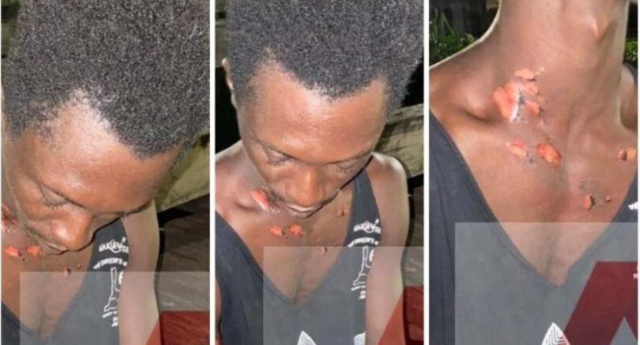 Man Arrested After Bathing 23-Year-Old Boy With Hot Water Over Girlfriend Photos