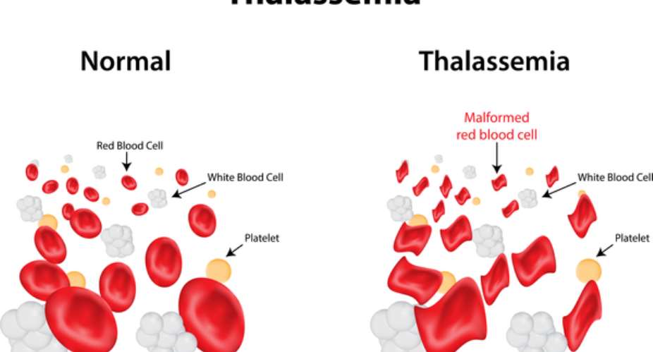 Myths and Reality associated with Thalassemia