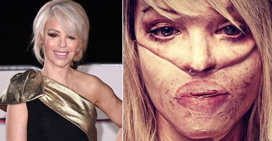 A horrific acid attack on a model in the United Kingdom