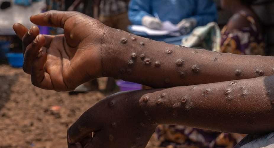 Ghana records first Mpox death amid rising infections
