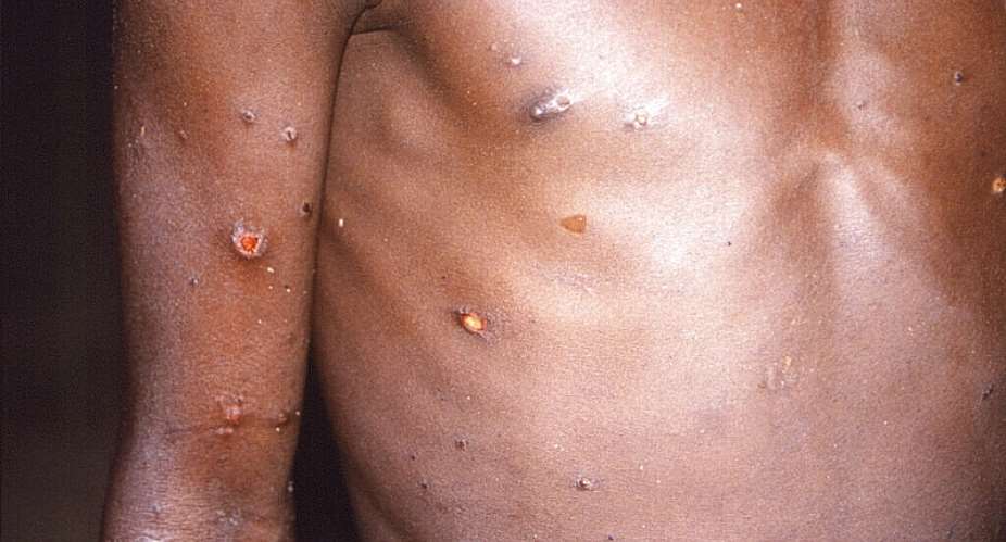 Despite deaths, Africa left to fight monkeypox without vaccine