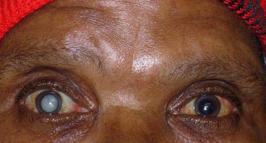 2.2 million Ghanaians eye fails to focus light properly on the retina, resulting in blurred vision – Prof. Boadi-Kusi