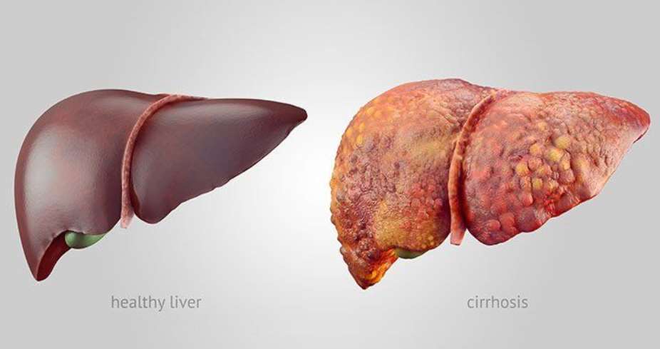 When the Keeper Falls Silent: How Liver Disease Can Hide in Plain Sight