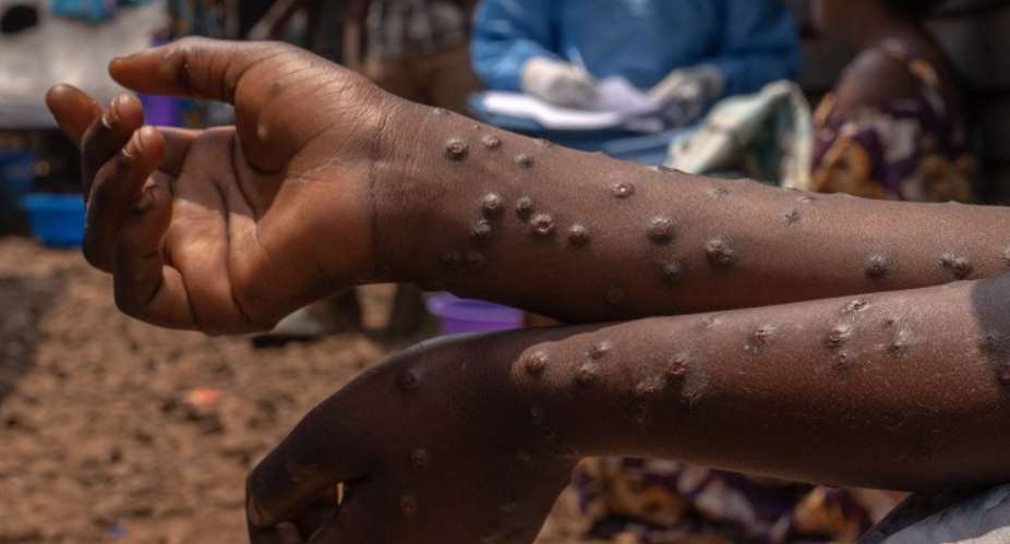 Ghana’s Mpox cases rise to 409
