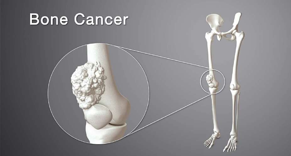 Limb-Saving Surgery Gives Children with Bone Cancer a Second Chance