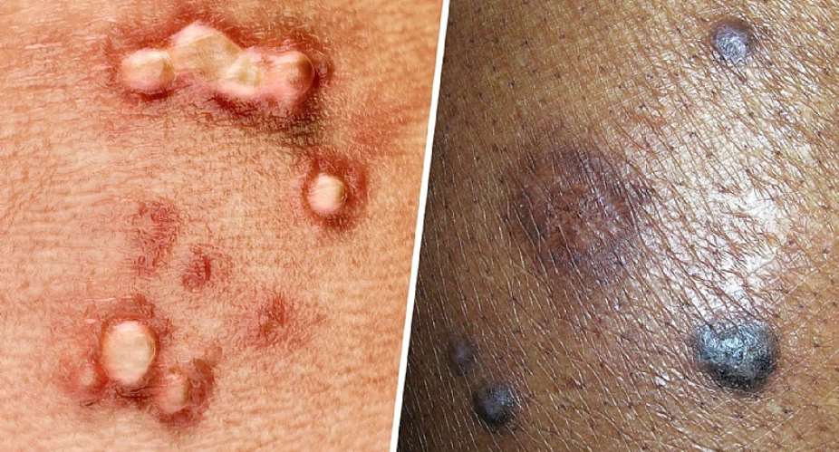 Human Papilloma Virus (HPV) Routine Vaccination Starting Soon In Ghana
