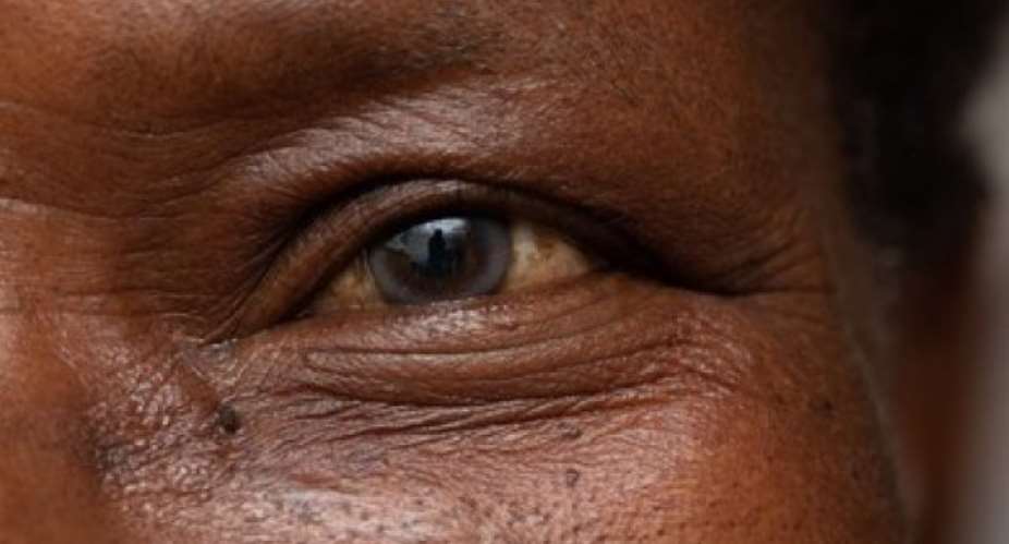 270 cataract cases recorded in Evalue-Ajomoro Gwira