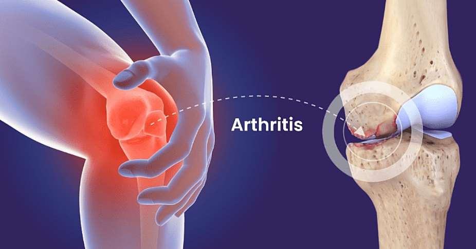 Dont Let Arthritis Take Over: Smart Ways to Fight Joint Pain