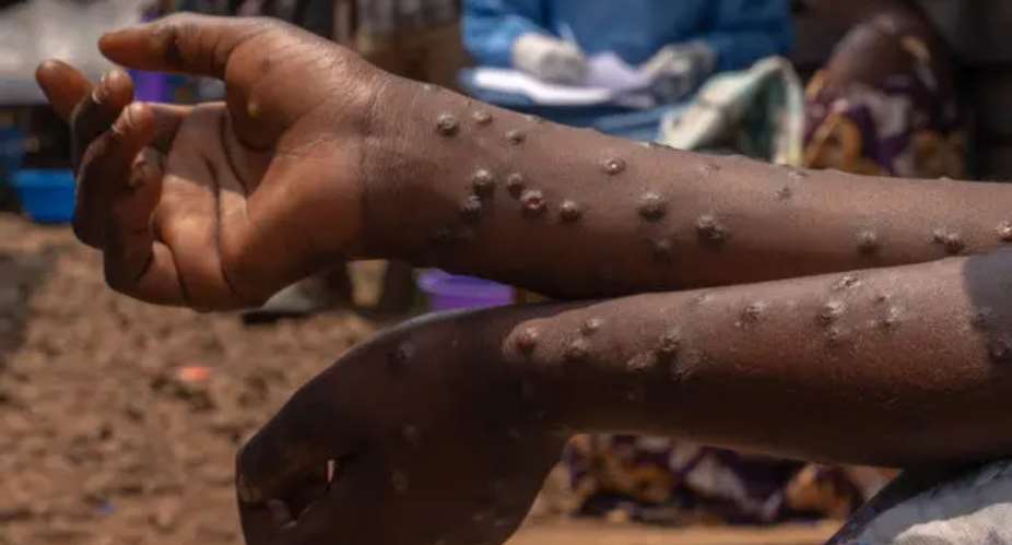 Western Region records Mpox death