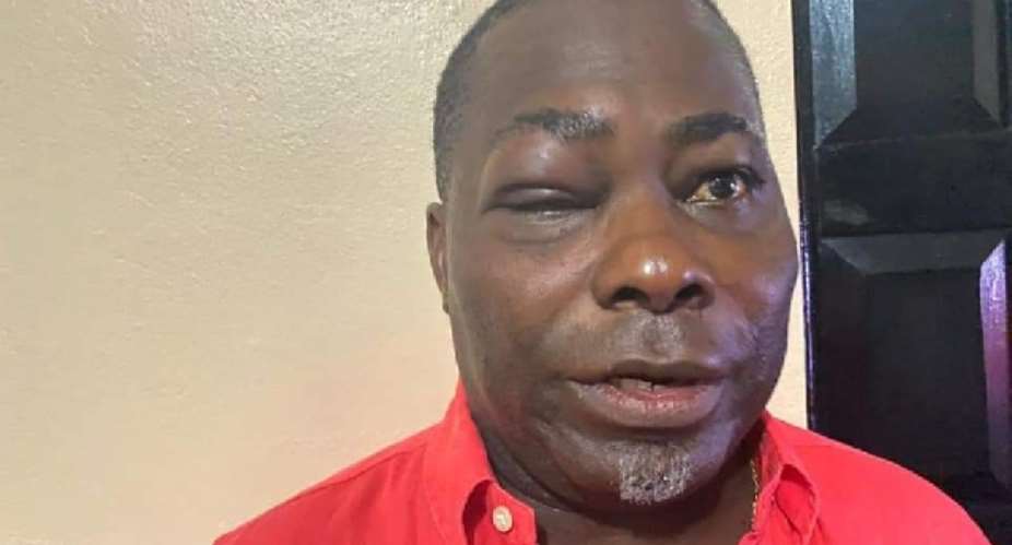 presidential staffer Charles Cromwell Nanabanyin Onuawonto Bissue with swollen face