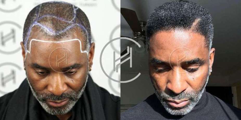 The Differences Between Traditional and Afro Hair Transplants