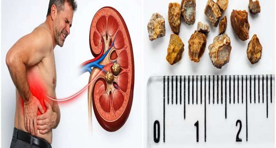 Kidney Stones Start Small but Can Hurt Big