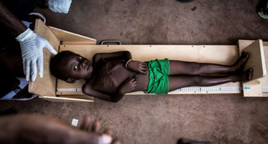 A malnourished child gets measured in a clinic treating cases of severe malnourishment in Tshikapa in the restive region of Kasai.  By JOHN WESSELS AFPFile