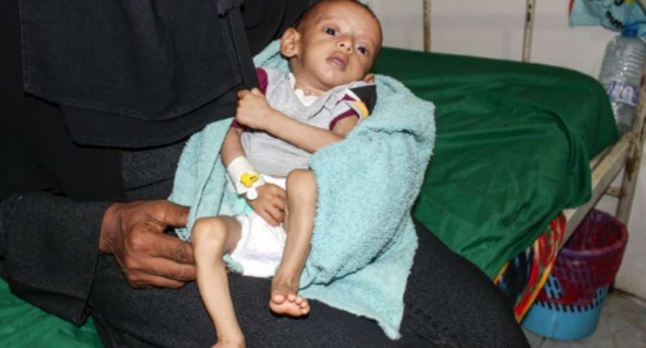 A malnourished child receiving treatment at a hospital in Yemen: a UN report said more than 821 million people worldwide suffered from hunger in 2018.  By - AFPFile