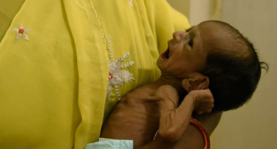 A malnourished newborn Indian baby is attended to by a nurse at a hospital in India's Telangana state.  By MONEY SHARMA AFP