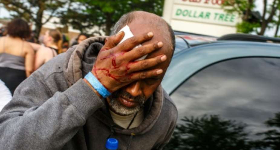A Somali-American man injured when protesters clashed with police during demonstrations against the death of George Floyd in  Minneapolis on May 27, 2020 -- African refugees have joined the protests against racism.  By Kerem Yucel AFPFile