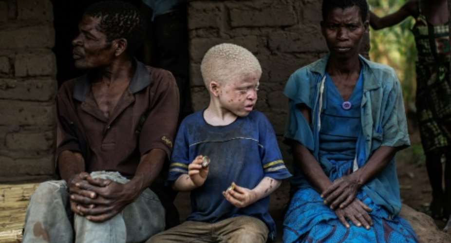 Up to 10,000 Malawians live with albinism, a hereditary condition that causes an absence of pigmentation in the skin.  By Gianluigi Guercia AFPFile