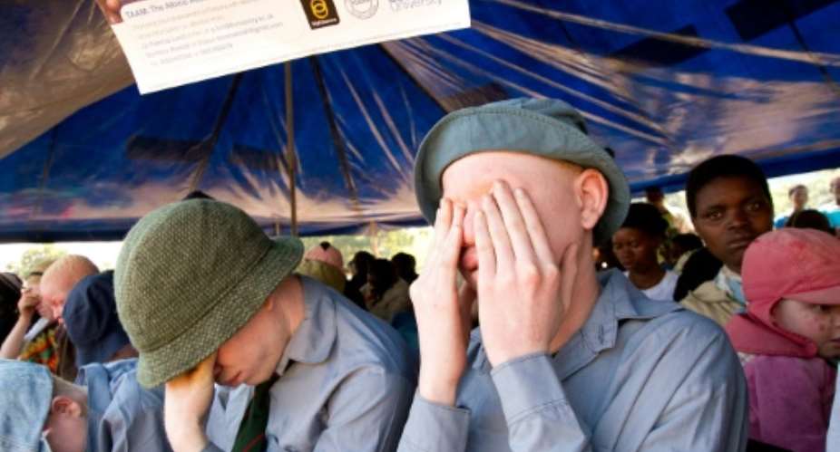 Malawi has seen a surge in attacks on people with albinism in recent years.  By ERICO WAGA AFPFile