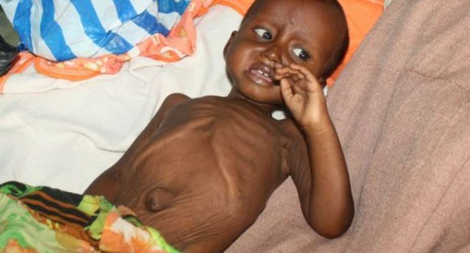 Ali Afrah, a severely malnourished child from southern Somalia, lies on a bed at Banadir hospital in Mogadishu.  By Abdurashid Abdulle (AFP)