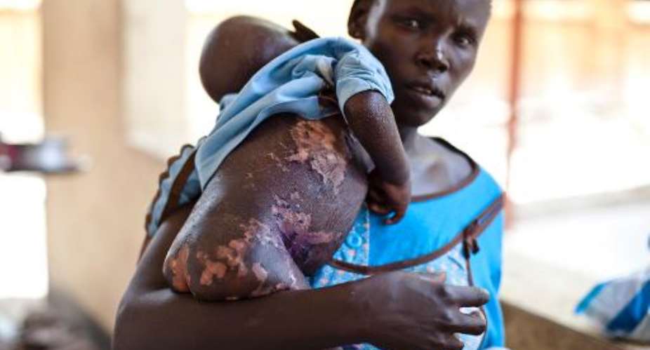 A woman holds her severely malnourished baby in the malnutrition ward of the El Sabbah Pediatric Hospital in Juba on March 14, 2014.  By Ivan Lieman AFPFile