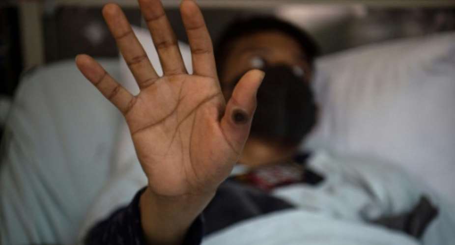 This file photo taken in 2022 shows a patient with a sore caused by monkeypox in Peru.  By Ernesto BENAVIDES (AFP/File)