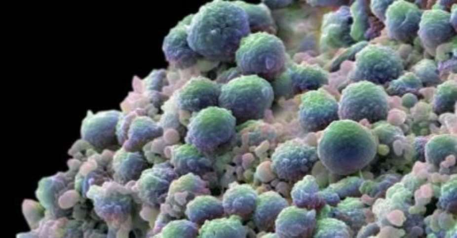 Close to 1,000 men diagnosed with prostate cancer in Ghana