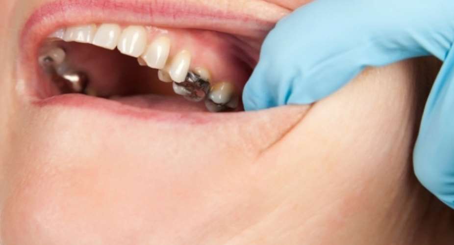 'Stop use of mercury in dentistry'