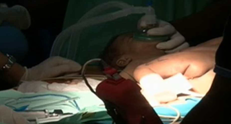 Conjoined twins born in CR but doctors say no separation
