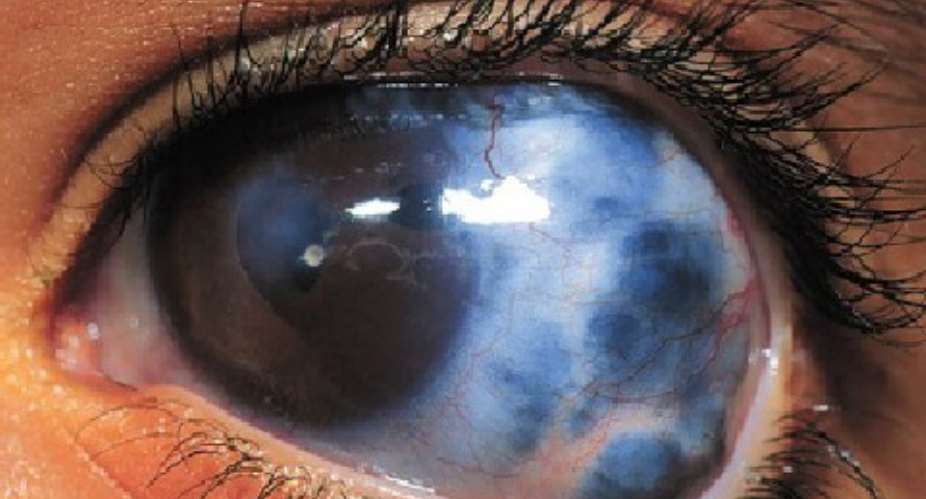 Over 700,000 Ghanaians suffering from glaucoma- Dr Debrah