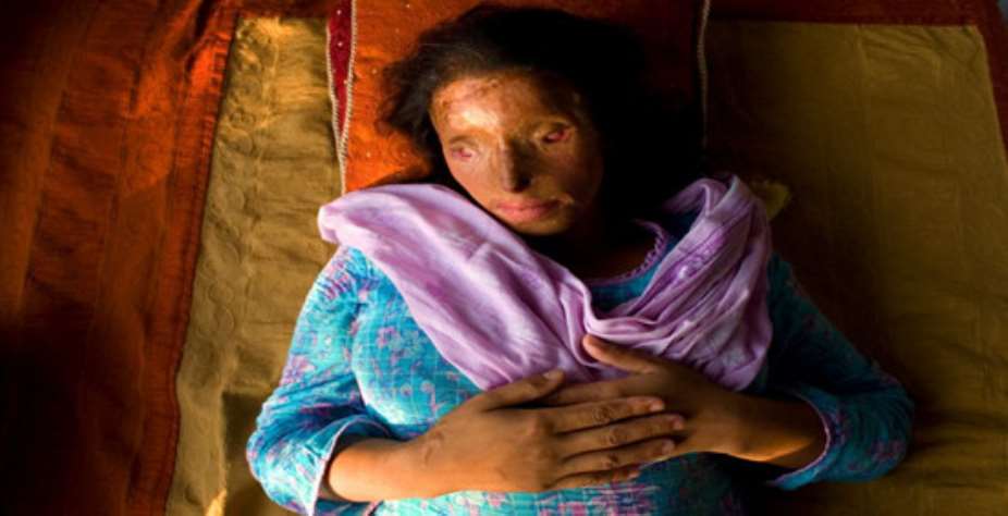 Nasreen Sharif, 26, an acid victim burned 11 years ago and who is completely blind, poses in 2007 in Islamabad, Pakistan. Paula BronsteinGetty