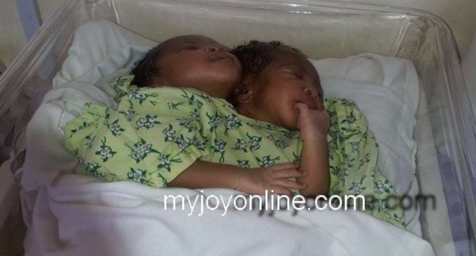 Swedish couple to adopt conjoined twins