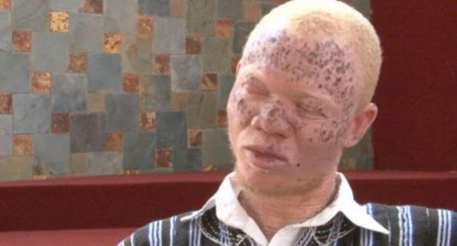 Albinos Fear Politicians Might Use Them For Election Rituals