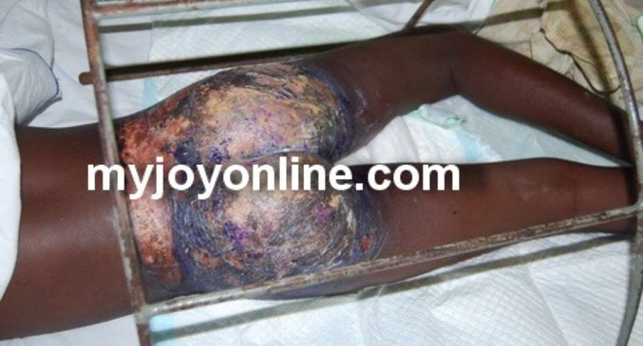 The burnt buttocks victim of the atrocious act