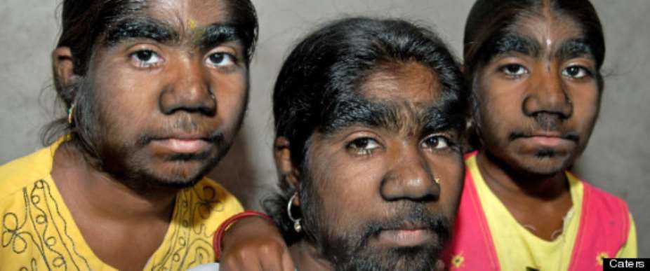 Hairy Werewolf Syndrome Sangli Sisters All Affected By Hypertricosis Universali