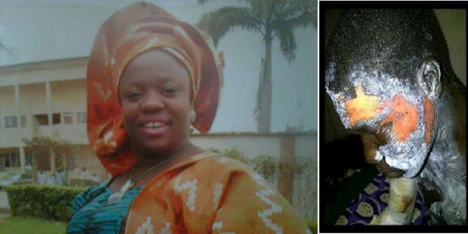 Mom Pours Hot Water On 18-Year Old Step Son While Asleep For Beating Her Daughter