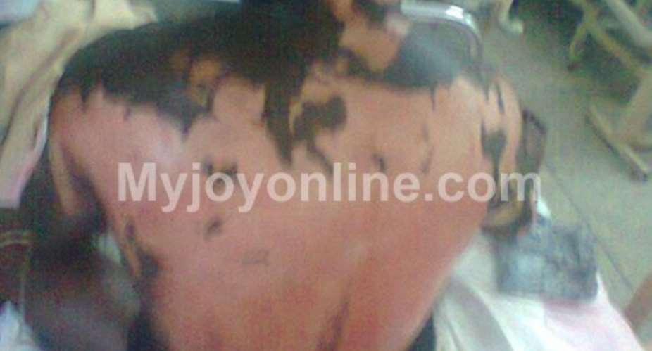 Adotey shows his burnt back as he responds to treatment at the hospital