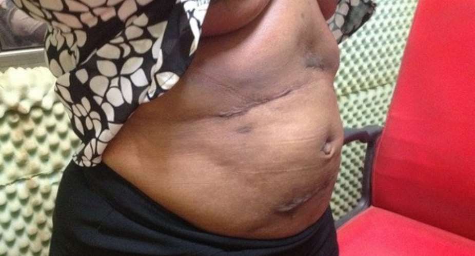 A woman showing her deformity to Joy News after undergoing surgery at Obengfo Hospital