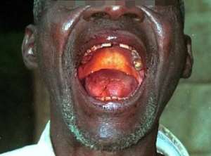 A victim of Ebola under examination opens the mouth