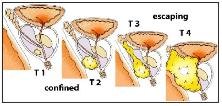 prostate-cancer-stages