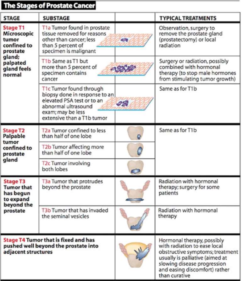 prostate-cancer-stages