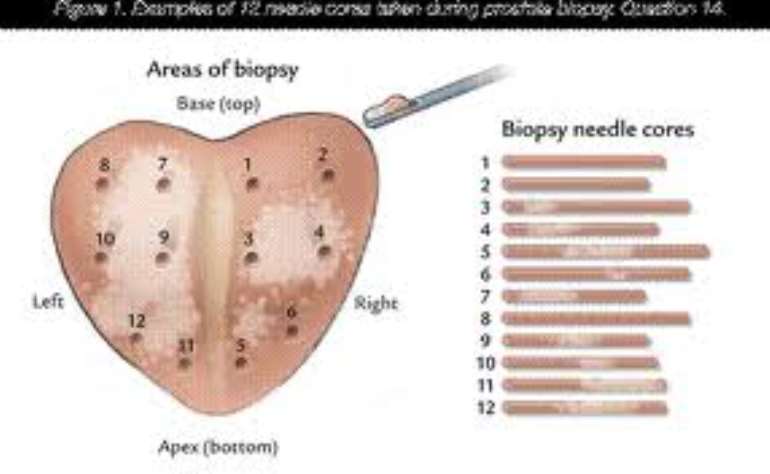 prostate-cancer-after-biopsy-what-does-it-mean