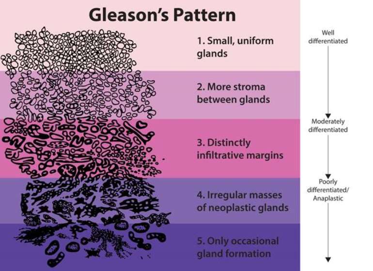 prostate-cancer-grading-system-urologic-pathology-division-johns