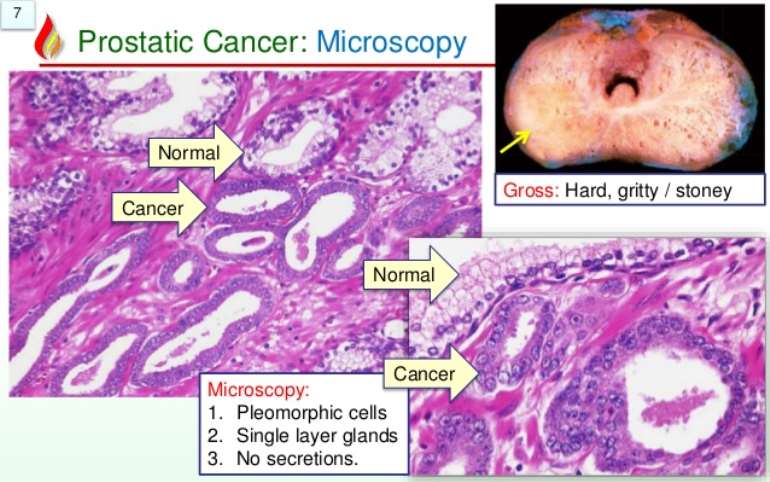 prostate-cancer-after-biopsy-what-does-it-mean