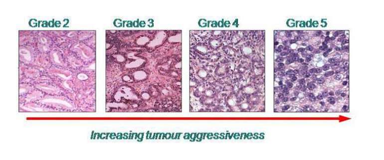 prostate-cancer-after-biopsy-what-does-it-mean