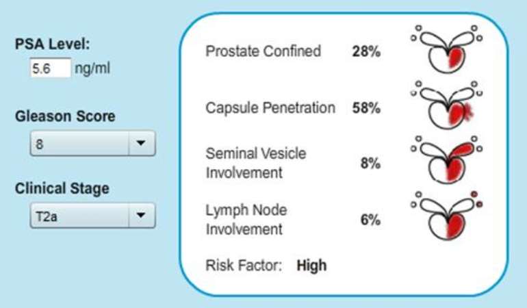 Gleason Score Understanding Your Prostate Pathology Report